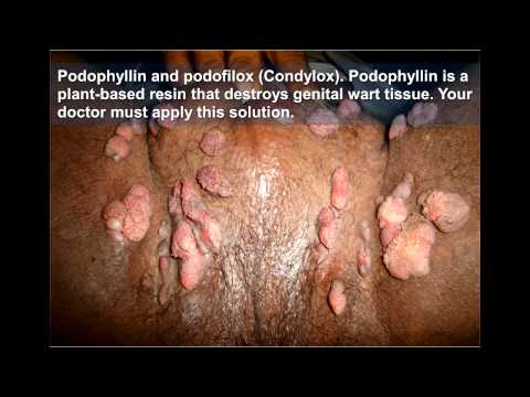 Genital Warts Treatment