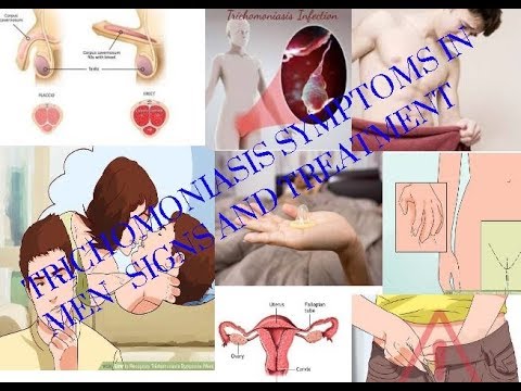 Trichomoniasis symptoms in men - signs and treatment
