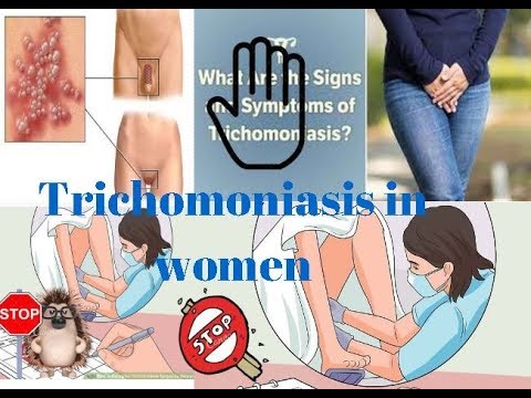 Trichomoniasis in women - signs and symptoms