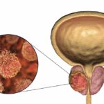 Rakovina prostaty - všetko o zhubnom ochorení predstojnej žľazy