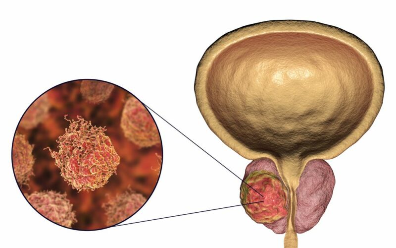 Rakovina prostaty