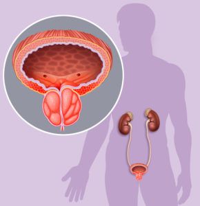 Zápal prostaty - prostatitis, prostatitída