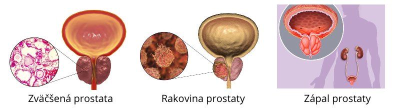 Prostata - zväčšená, rakovina prostaty a zápal prostaty