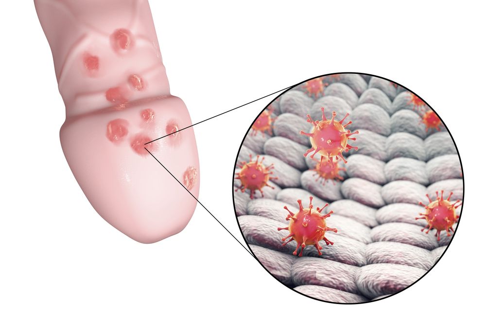 Genitálny herpes u mužov - detail, vírus