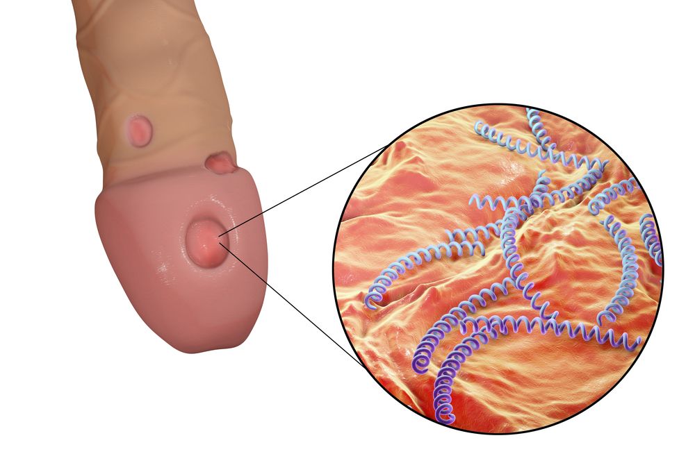 Syfilis - tvrdý vred, ulcus durum na penise
