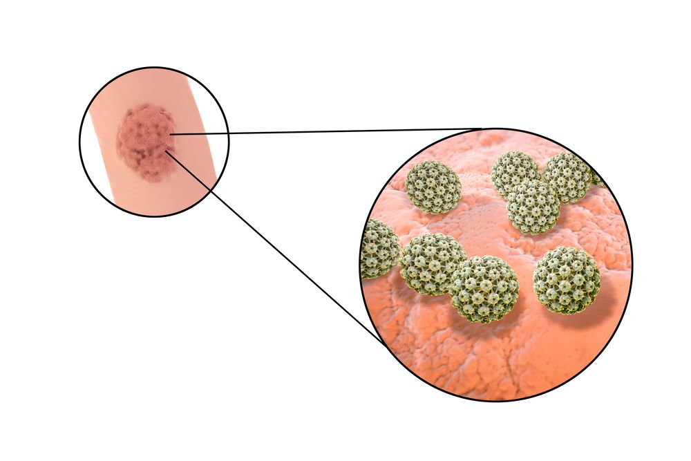 Genitálne bradavice - detail, ľudský papillomavirus HPV