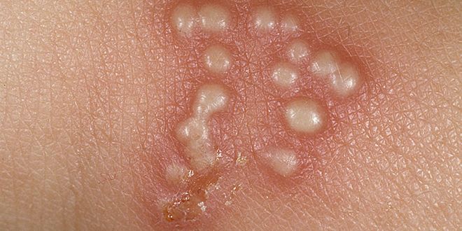 Genitálny herpes - pľuzgiere vyvolané herpes siplex virus