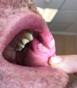syfilis v ústach - sekundárna infekcia