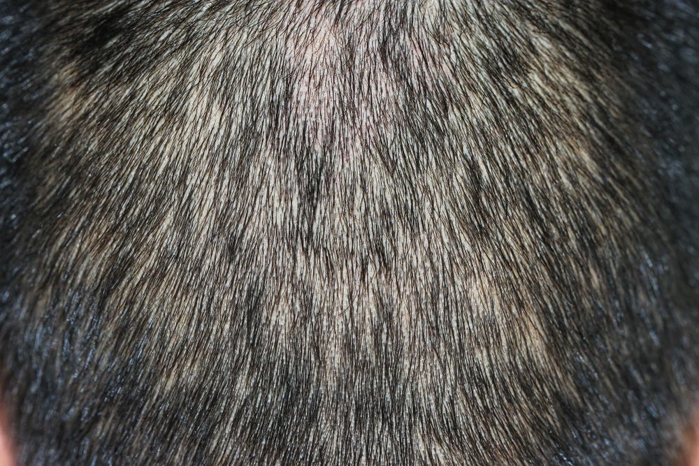 Vypadávanie vlasov - alopécia v druhom štádiu syfilisu